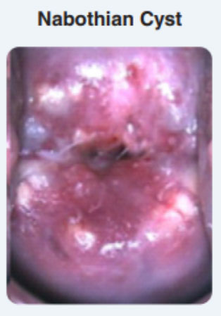 Nabothian follicles