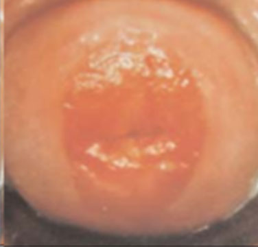 cervical ectropion