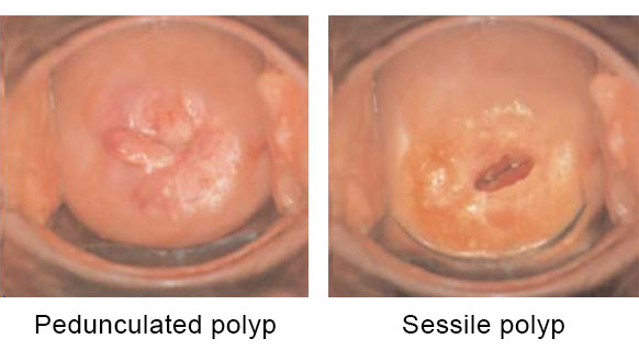 cervical polyp